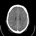 Computed tomography of brain of Mikael Häggström (20).png