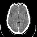 Computed tomography of brain of Mikael Häggström (13).png