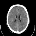 Computed tomography of brain of Mikael Häggström (19).png