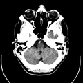 Computed tomography of brain of Mikael Häggström (5).png