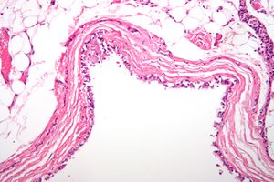 Bronchogenic cyst high mag.jpg