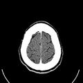 Computed tomography of brain of Mikael Häggström (28).png