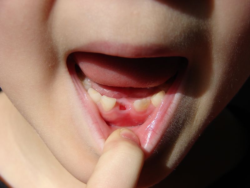 ملف:ToothLost-2917.jpg