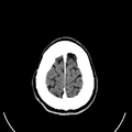 Computed tomography of brain of Mikael Häggström (29).png