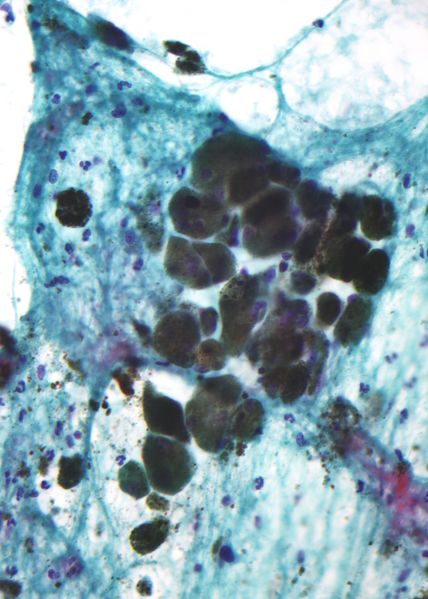ملف:Pigmented melanoma - cytology.jpg