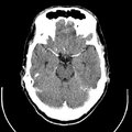 Computed tomography of brain of Mikael Häggström (10).png