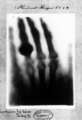 A print of one of the first X-rays by Wilhelm Röntgen (1845–1923) of the left hand of his wife Anna Bertha Ludwig. It was presented to Professor Ludwig Zehnder of the Physik Institut, University of Freiburg, on 1 January 1896.