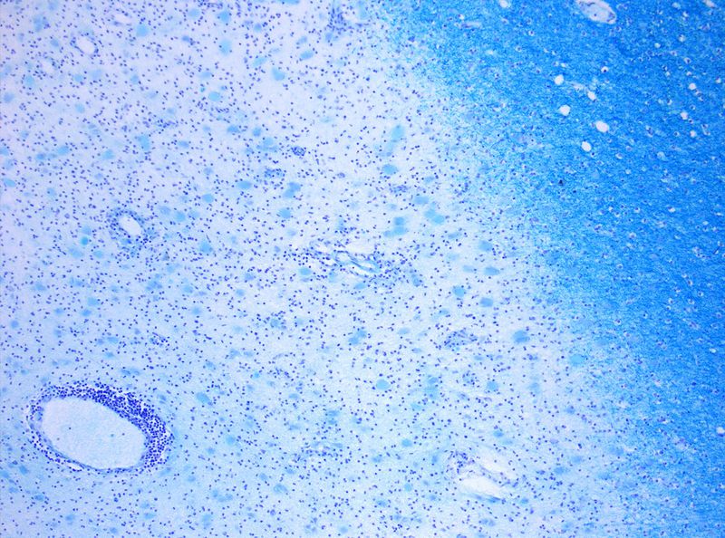 ملف:MS Demyelinisation KB 10x.jpg