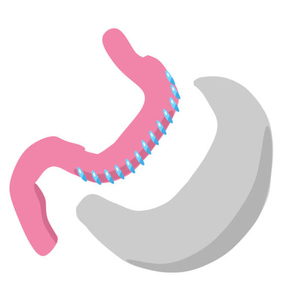 ملف:Gastric sleeve icon.svg