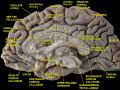 Medial surface of cerebral hemisphere.Medial view.Deep dissection.