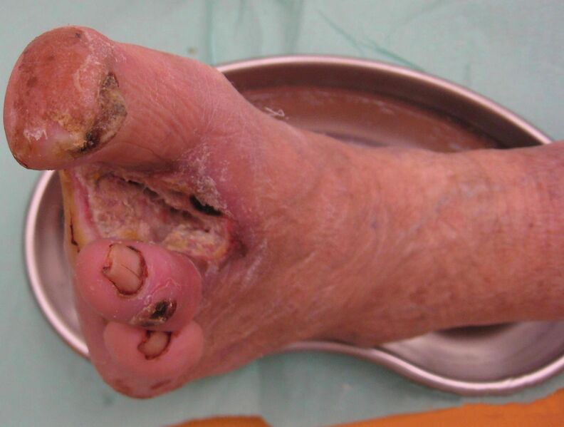 ملف:Diabetic Wound.jpg