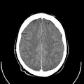 Computed tomography of brain of Mikael Häggström (22).png