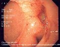 Endoscopic image of a posterior wall قرحة الإثنا عشر with a clean base, الذي هو سبب شائع للنزيف في السبيل الهضمي العلوي.