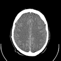 Computed tomography of brain of Mikael Häggström (21).png