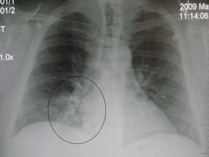 ملف:RLL pneumoniaM.jpg