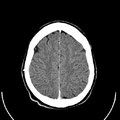Computed tomography of brain of Mikael Häggström (24).png